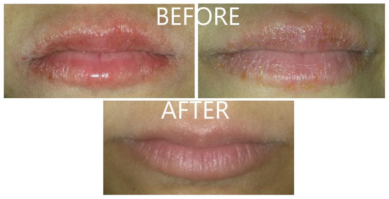 Accutane Users Amazing Cure For Cracked And Chapped Lips