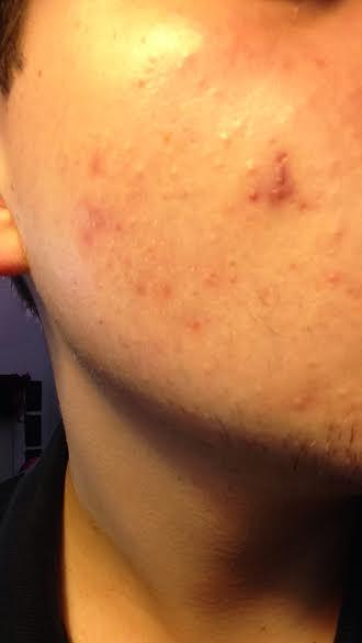 newestacne2.jpg