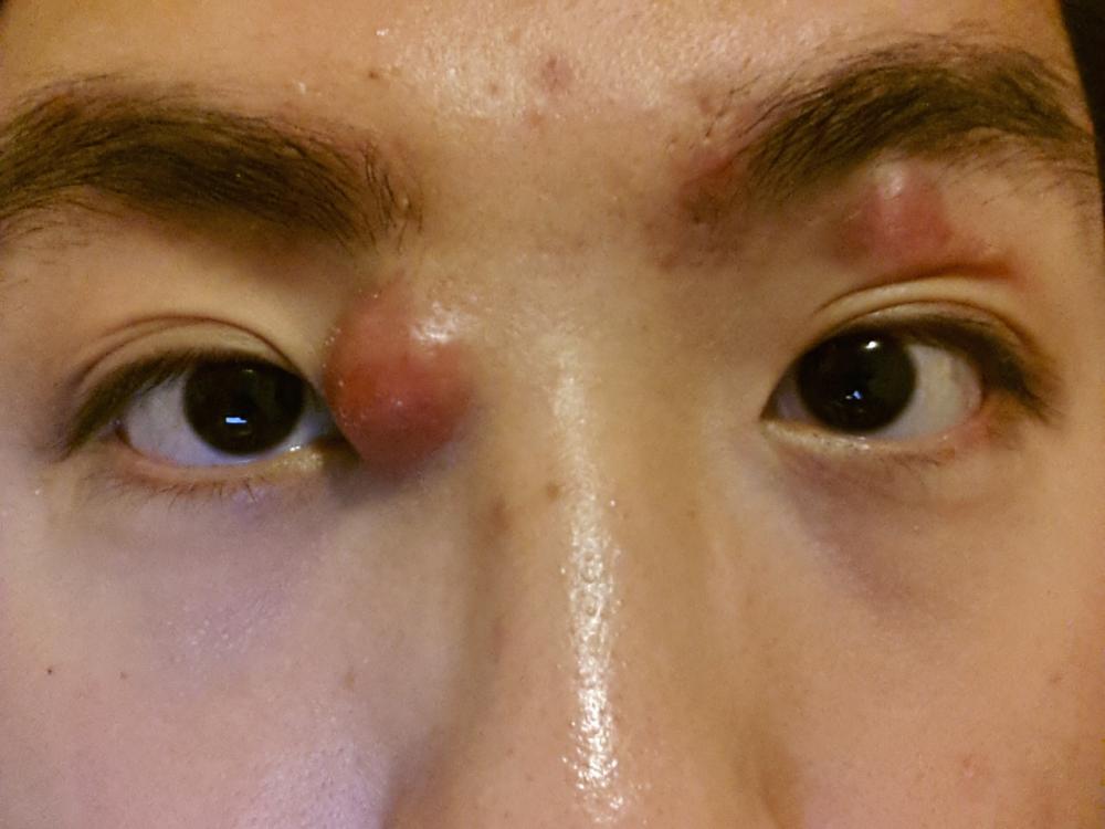 Acne? near eye.... - General acne discussion - by AnmolRai ...