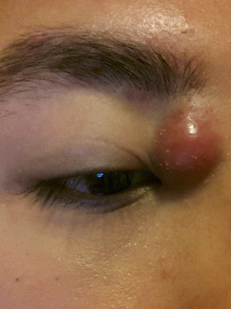 Acne? near eye.... - General acne discussion - by AnmolRai ...