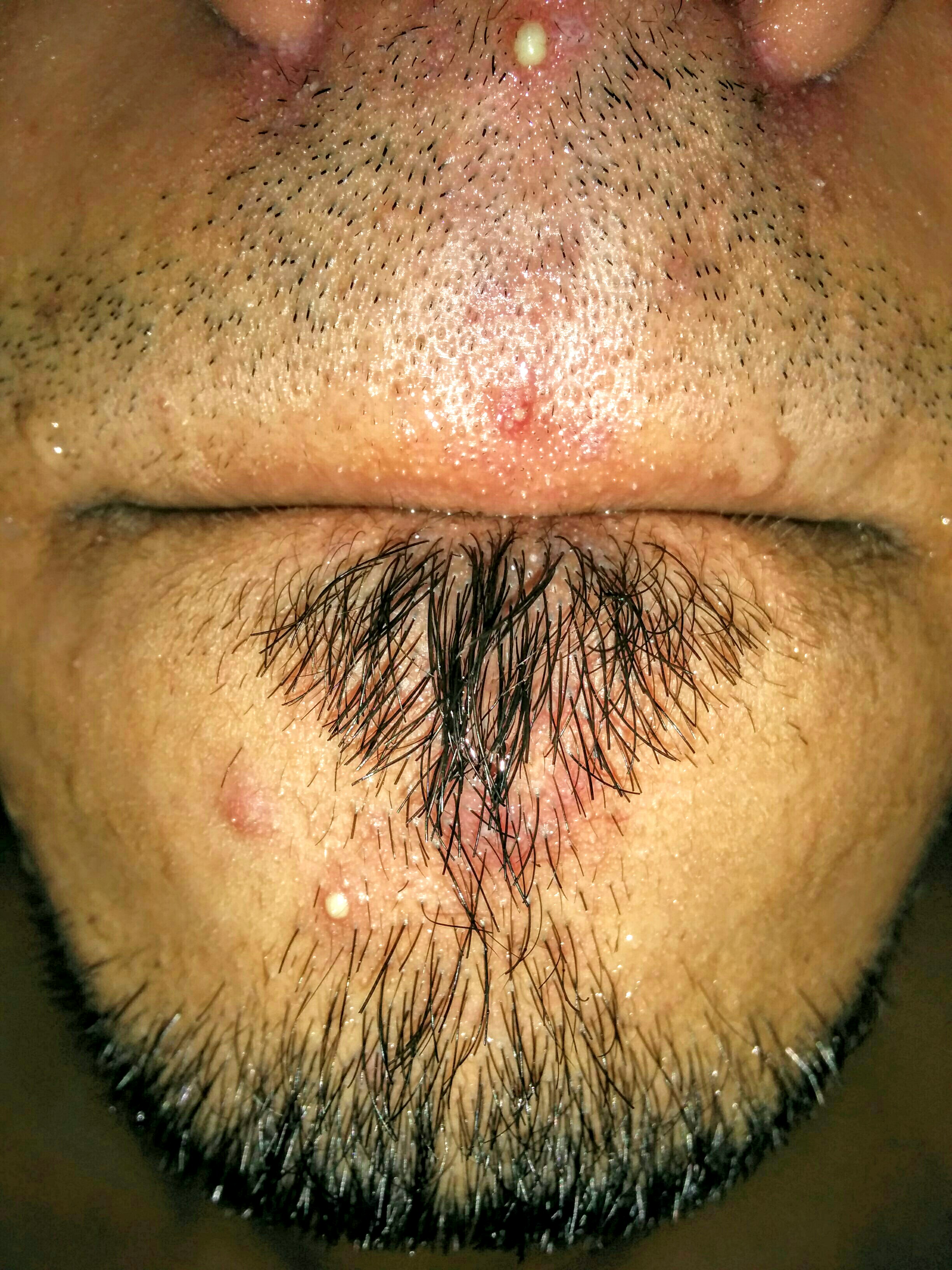 White Pustules Around Mouth/nose. Pictures Included ...