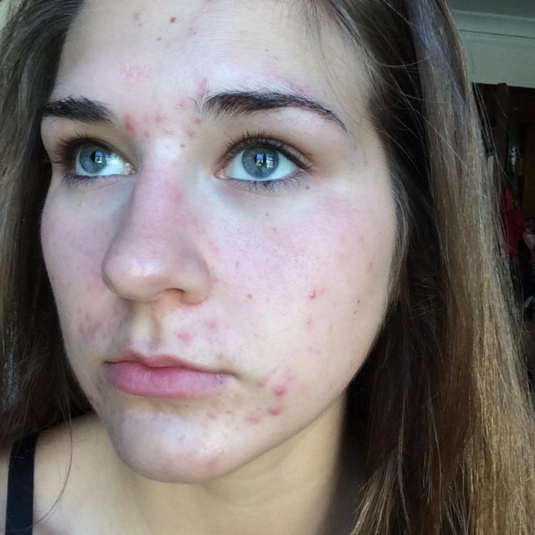 Accutane work time does second