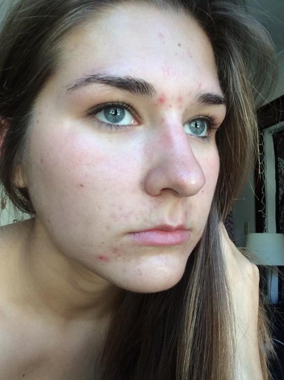 Second time accutane users