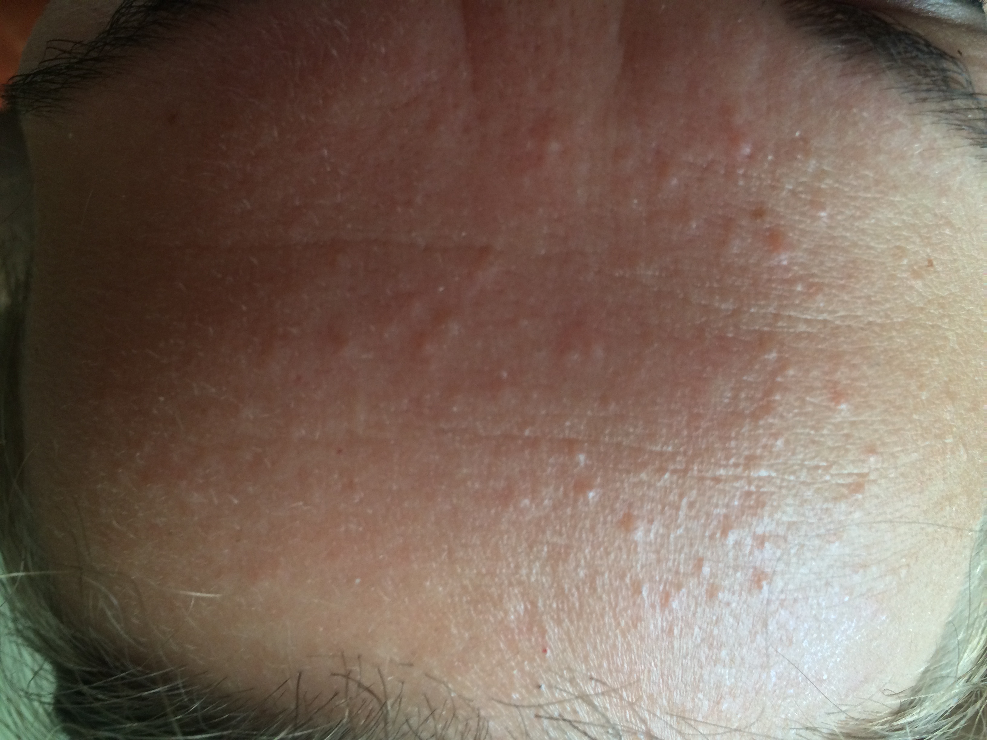 Candida Acne On Forehead