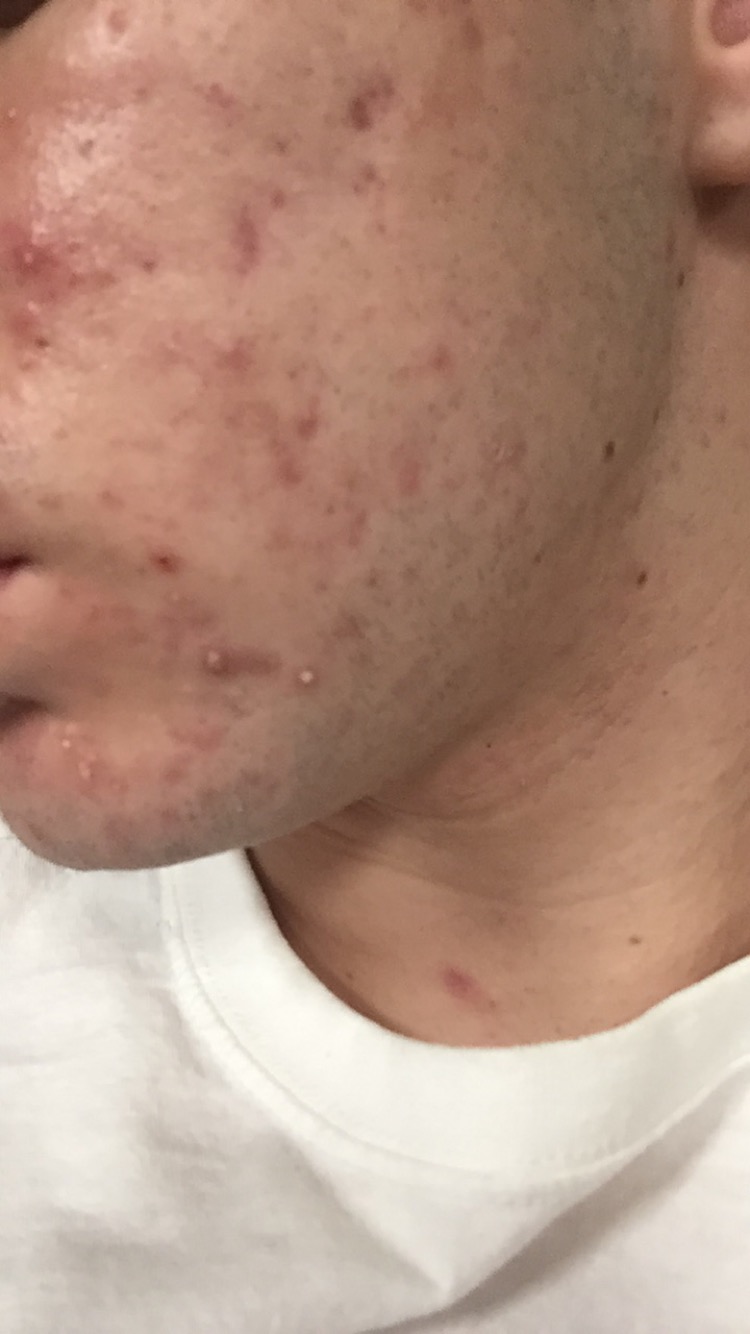17 year old, severe acne, scars and redness - General acne discussion