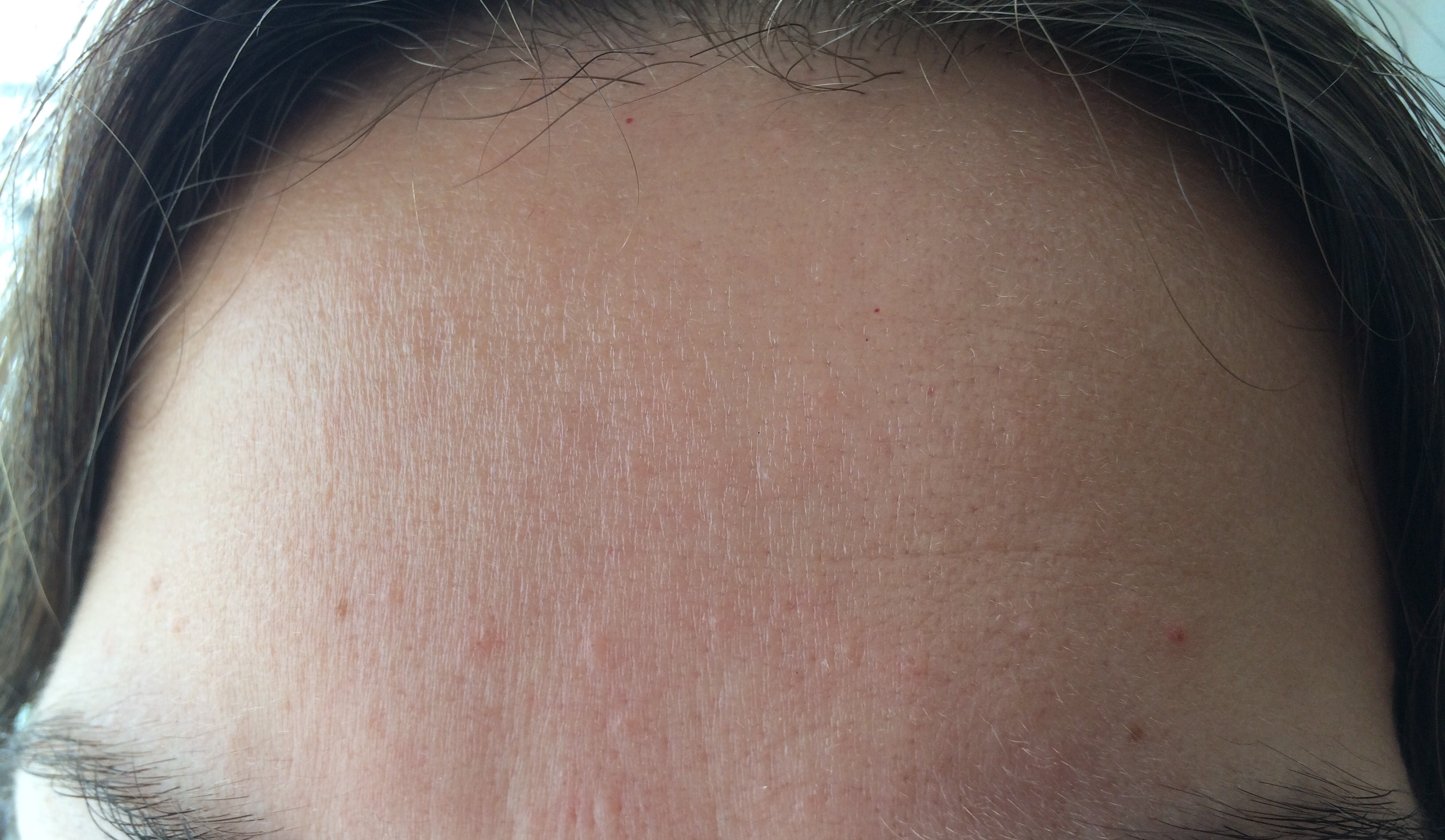 bumps-on-forehead-pictures-photos-vrogue-co