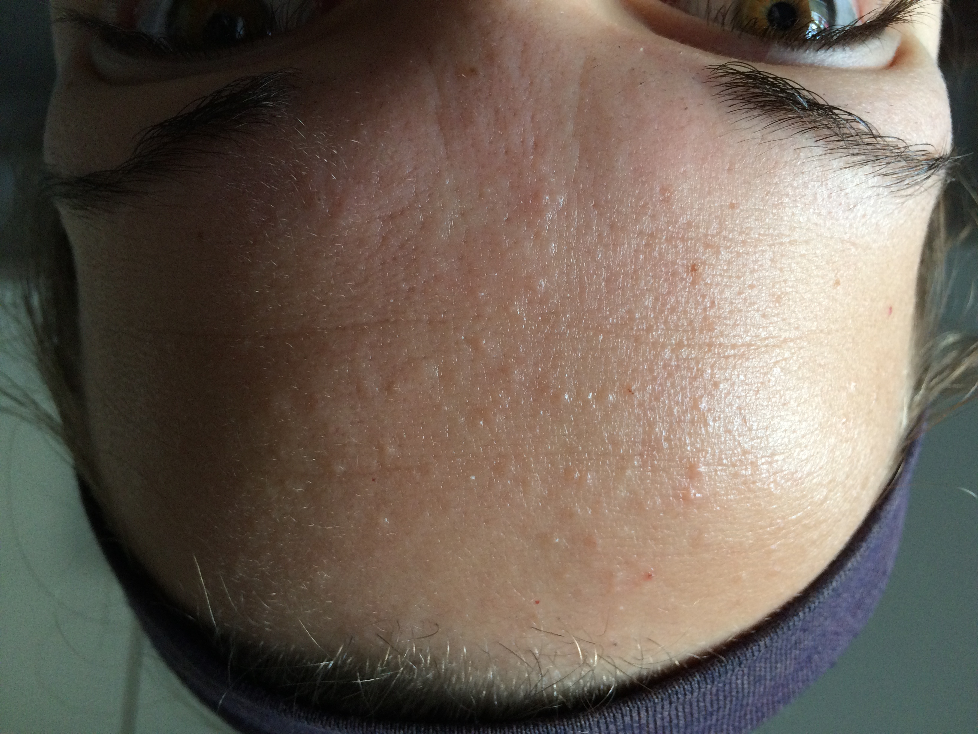 Small Flesh Colored Bumps On Forehead And Hairline Adult Acne