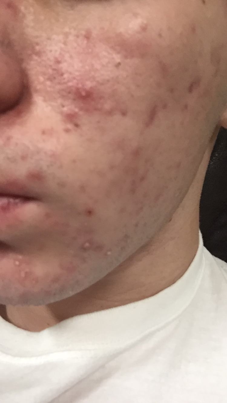 17 Year Old Severe Acne Scars And Redness General Acne Discussion