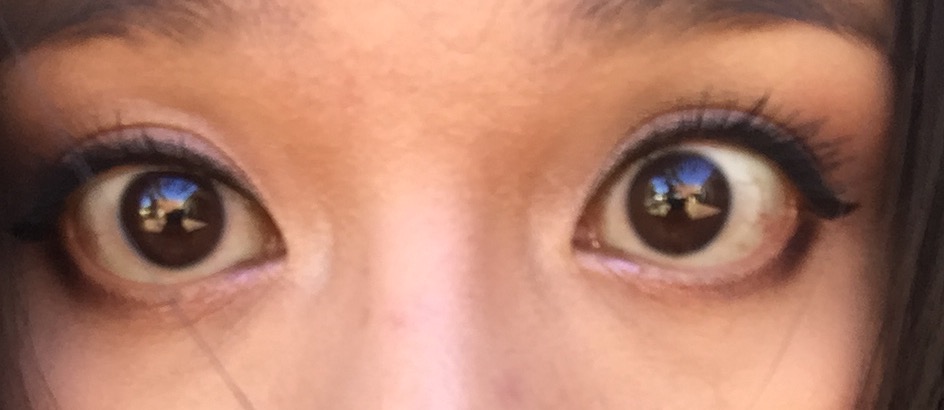 from severe dry accutane eyes