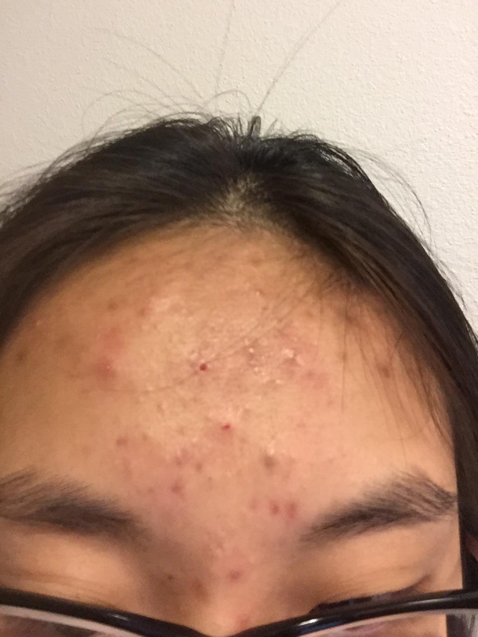 Acne Help General Acne Discussion Forum