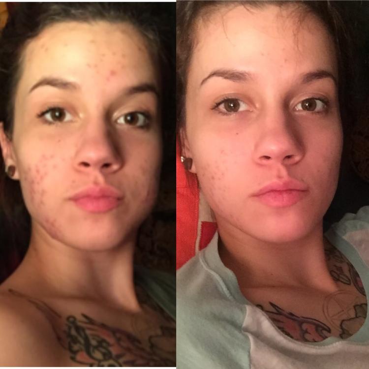 How I cleared my skin in 2 months. - General acne 