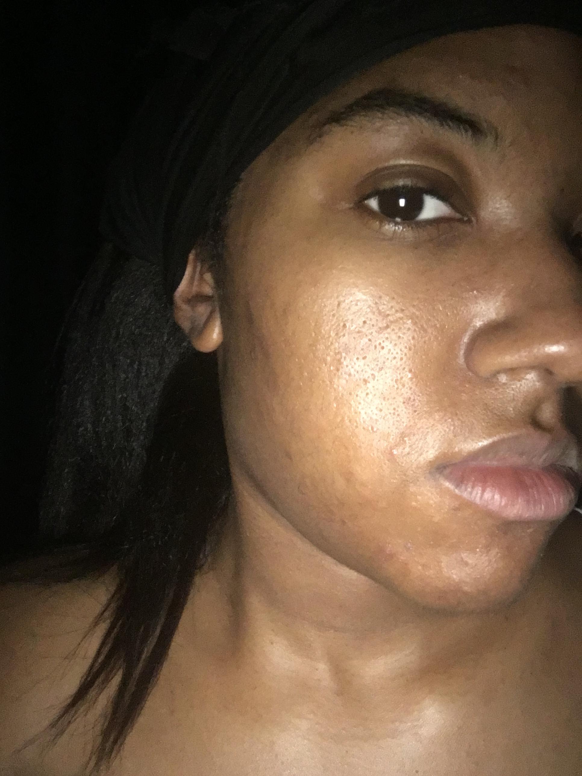 Could You Be Using Too Much ? - General acne discussion Could You Be Using Too Much ? - General acne discussion
