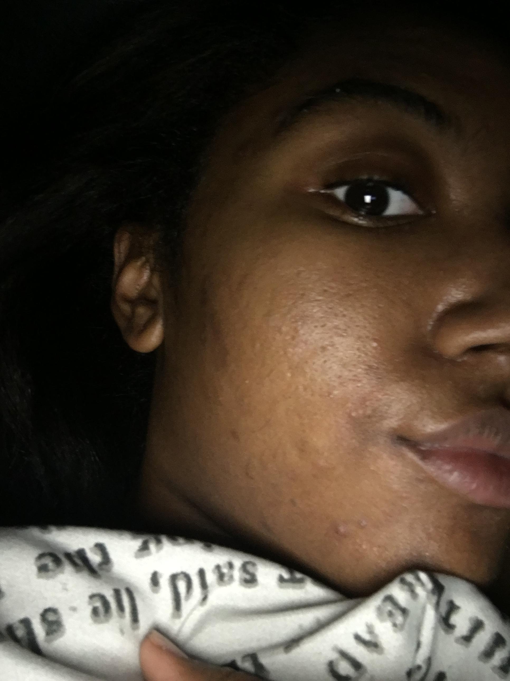 Could You Be Using Too Much ? - General acne discussion Could You Be Using Too Much ? - General acne discussion