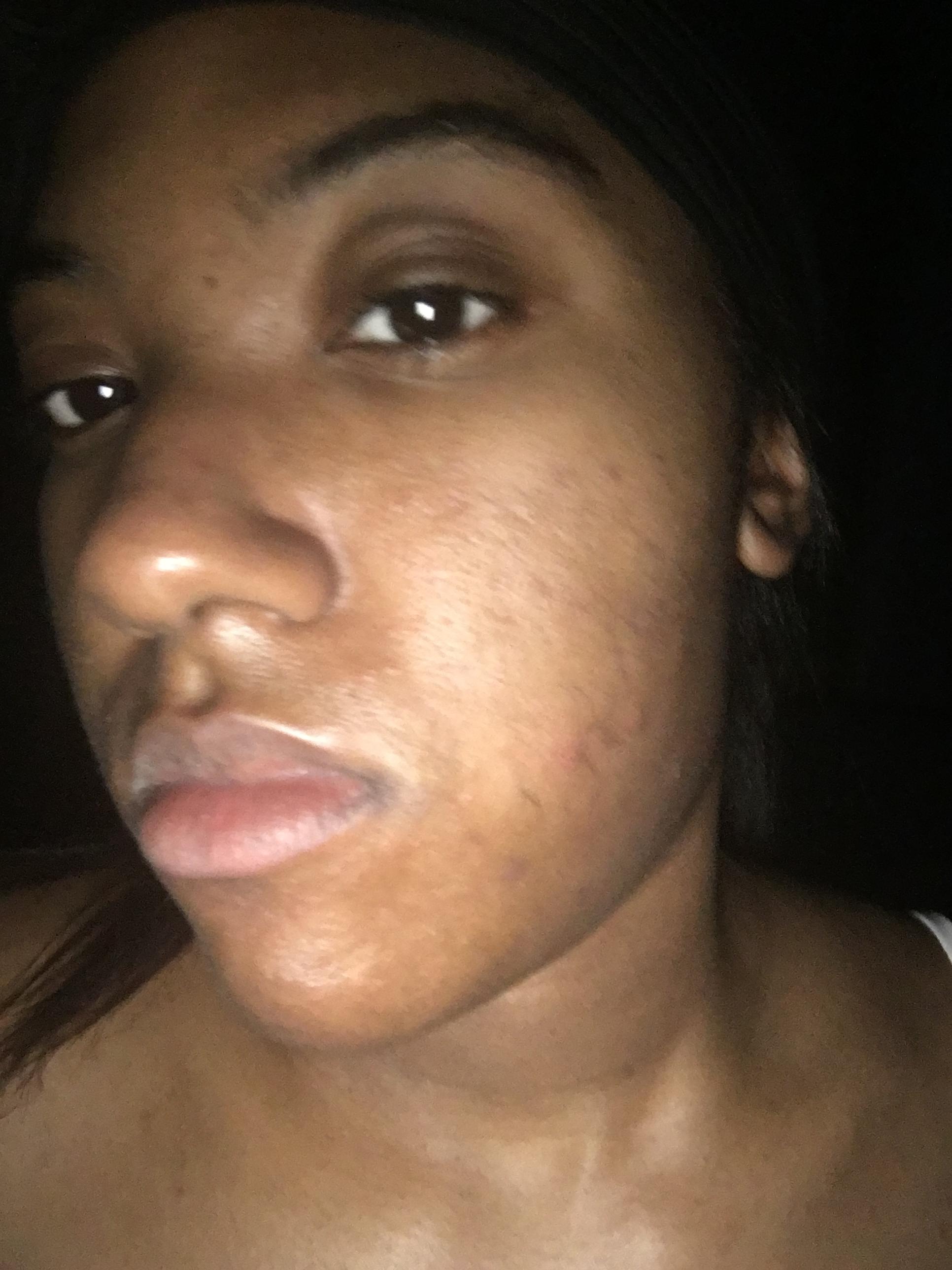 Could You Be Using Too Much ? - General acne discussion Could You Be Using Too Much ? - General acne discussion