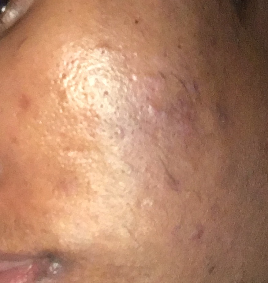 Could You Be Using Too Much ? - General acne discussion Could You Be Using Too Much ? - General acne discussion
