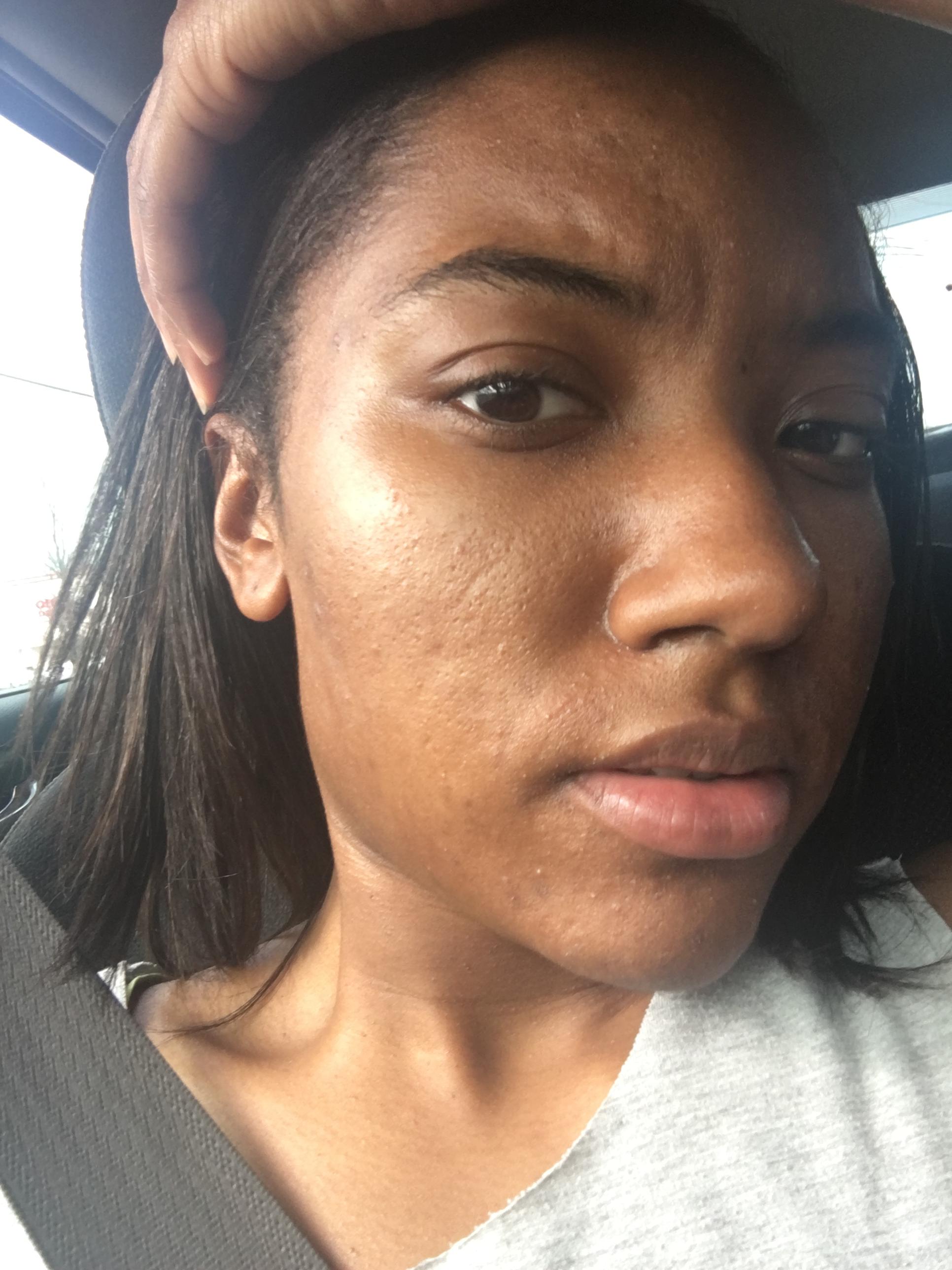 Water, Facial Wash, and Mosturizer - Over-the-counter acne Water, Facial Wash, and Mosturizer - Over-the-counter acne