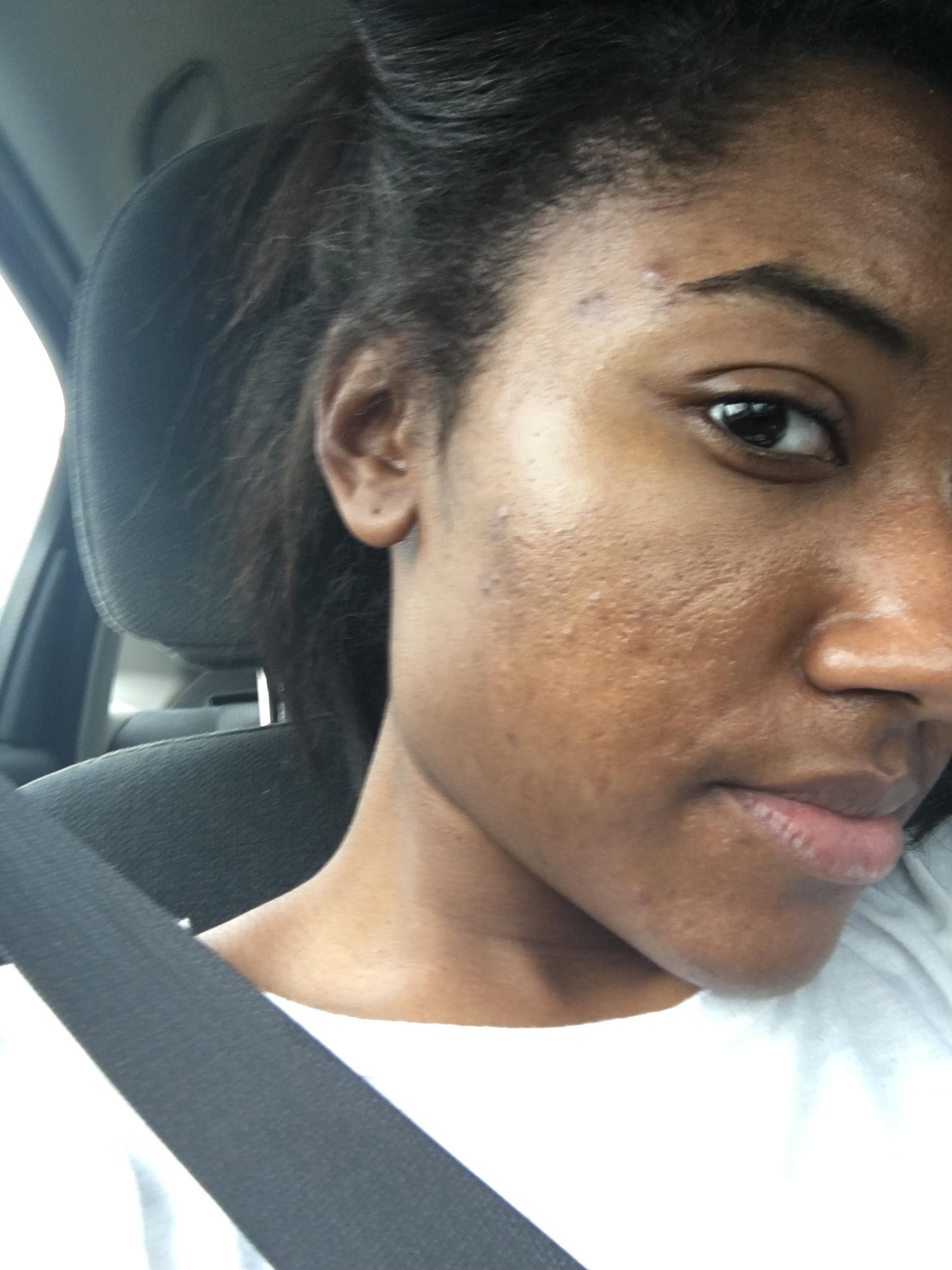 Could You Be Using Too Much ? - General acne discussion Could You Be Using Too Much ? - General acne discussion