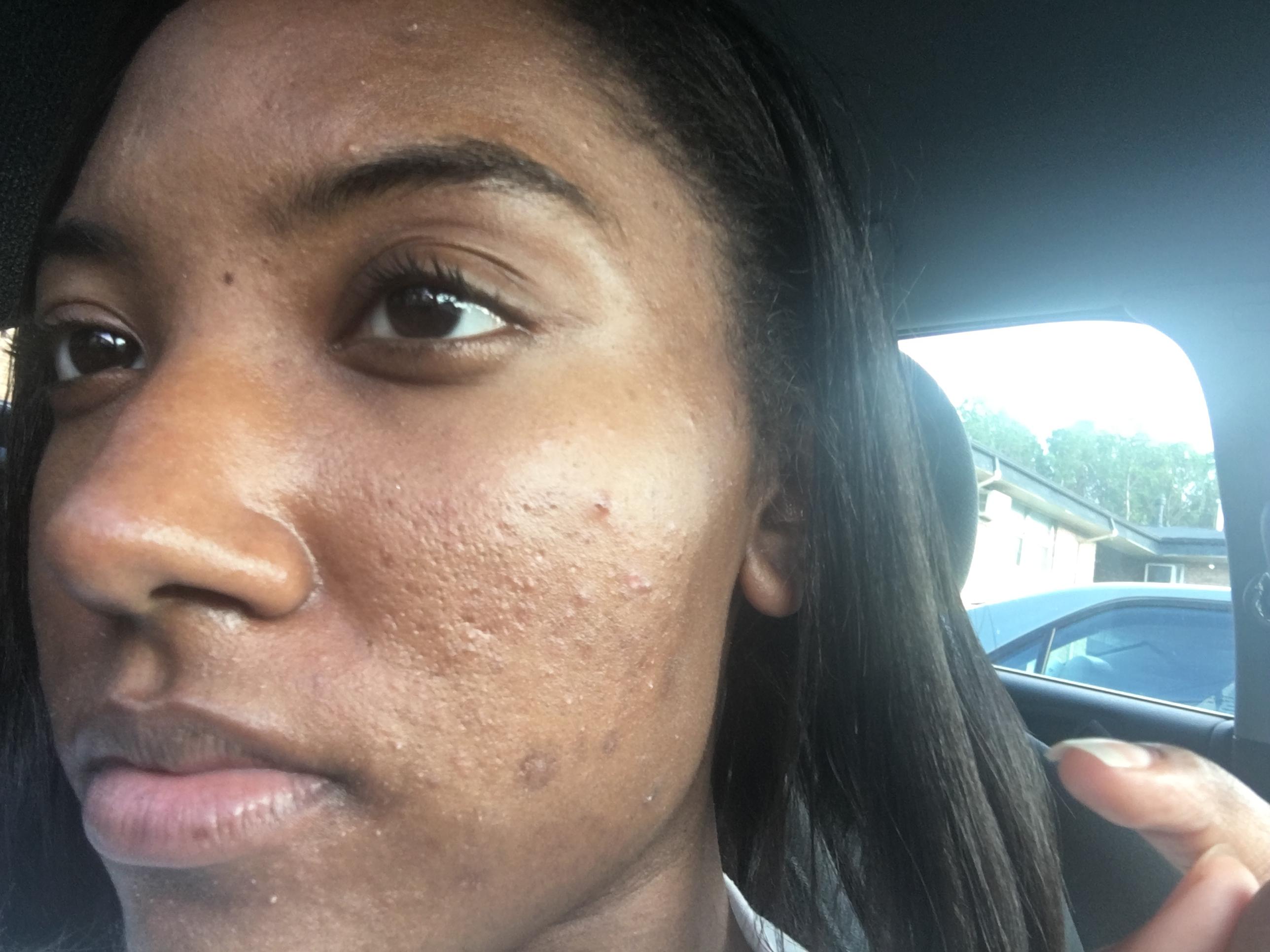 Could You Be Using Too Much ? - General acne discussion Could You Be Using Too Much ? - General acne discussion