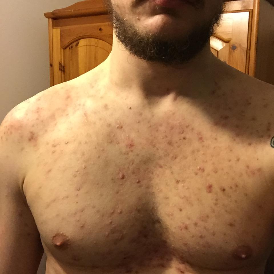 Bad body scars from acne, please help:/ - Scar treatments - Acne.org