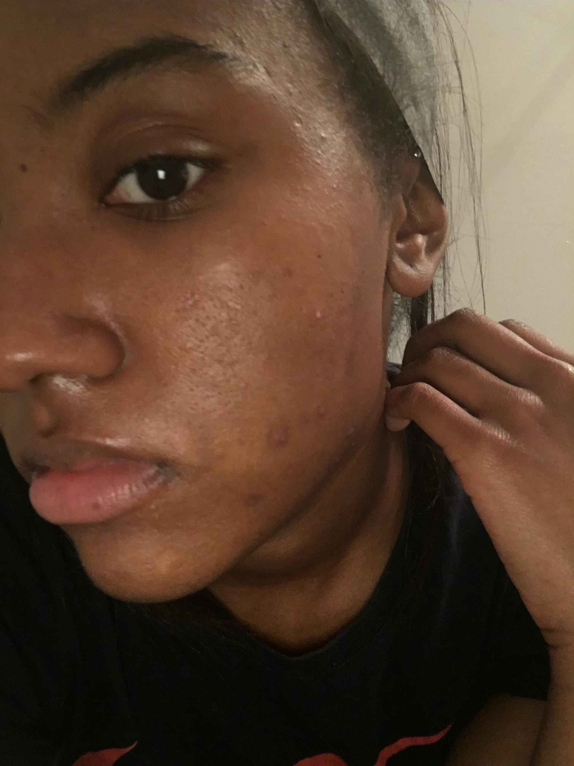 Could You Be Using Too Much ? - General acne discussion Could You Be Using Too Much ? - General acne discussion
