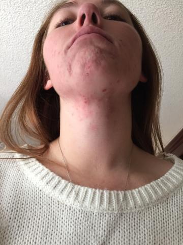 Roaccutane Billig