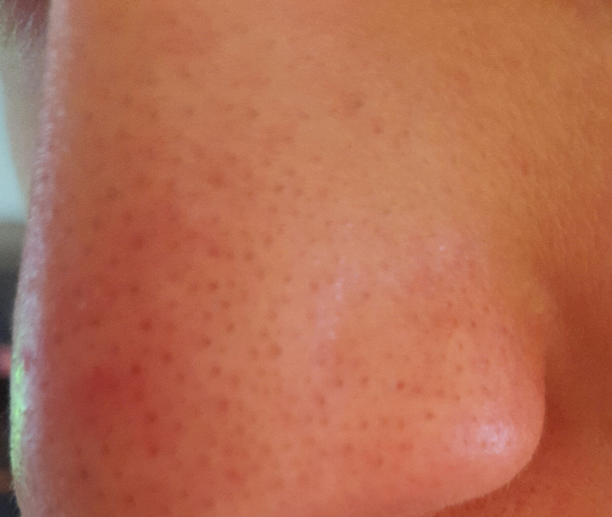 Acne and Sport: What's the Connection? sebaceous filaments or blackheads - Oily skin - Acne.org ...