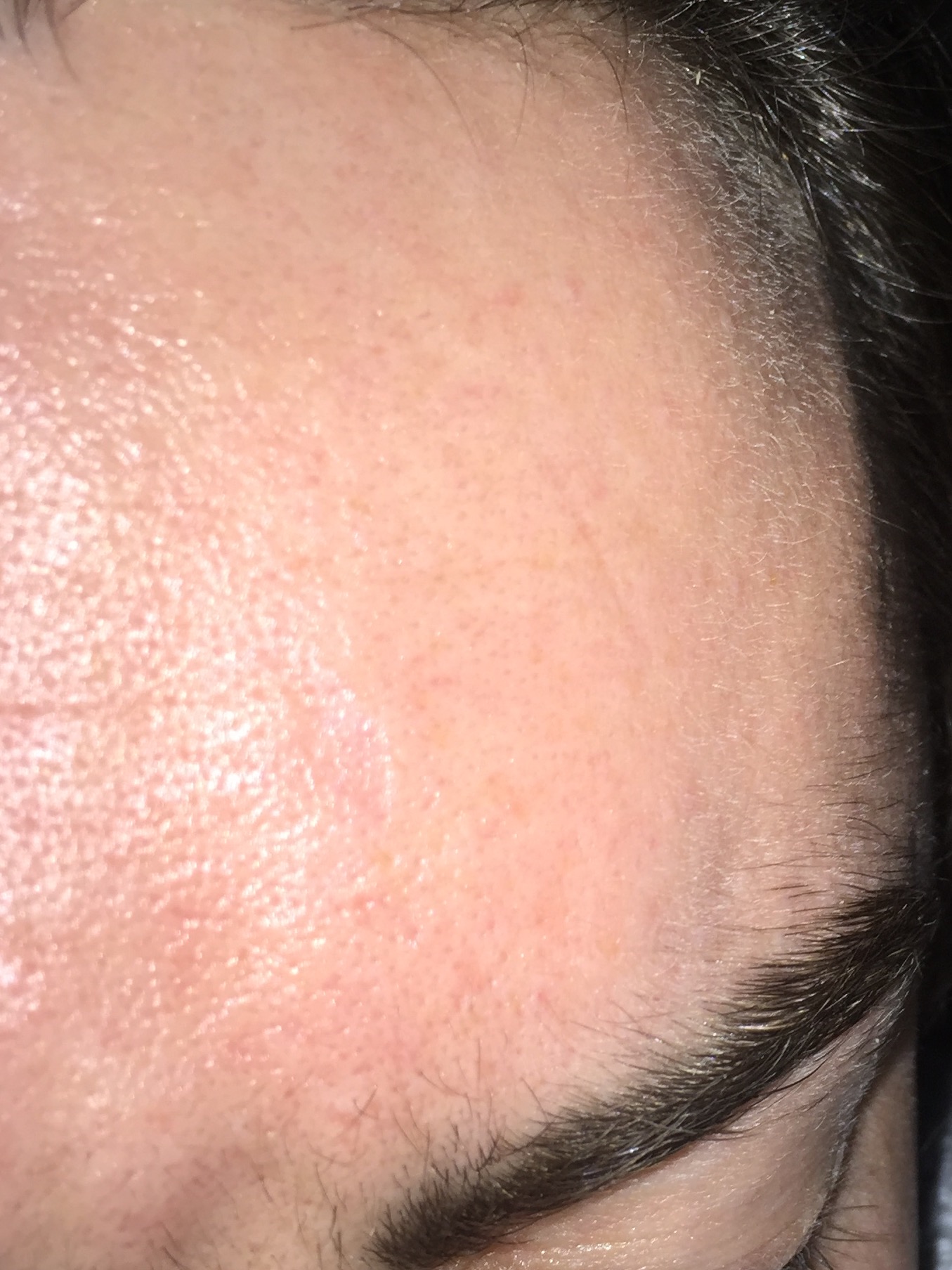 Pores will accutane shrink