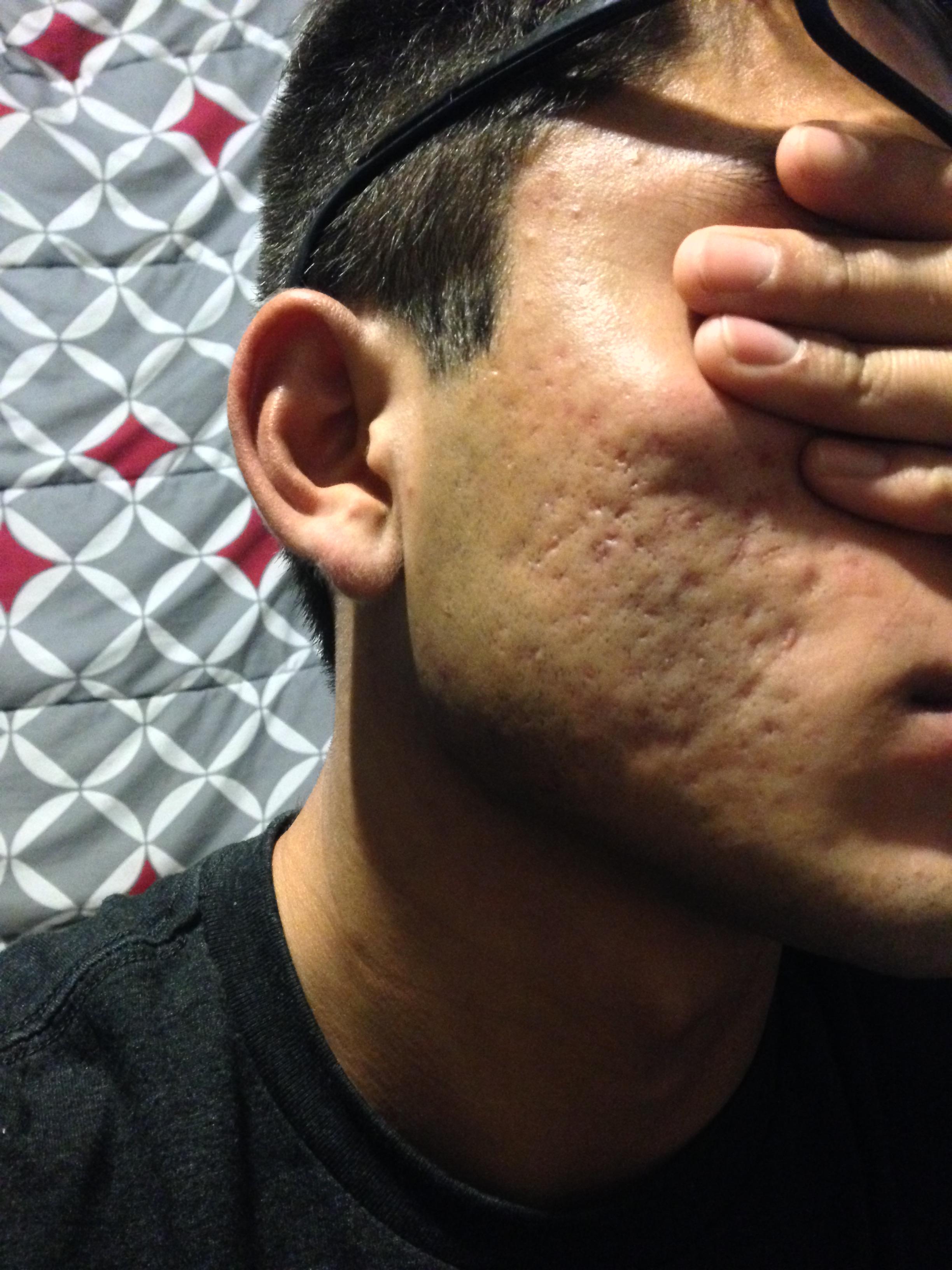 Please help with acne scars (Pics) - Scar treatments - Acne.org