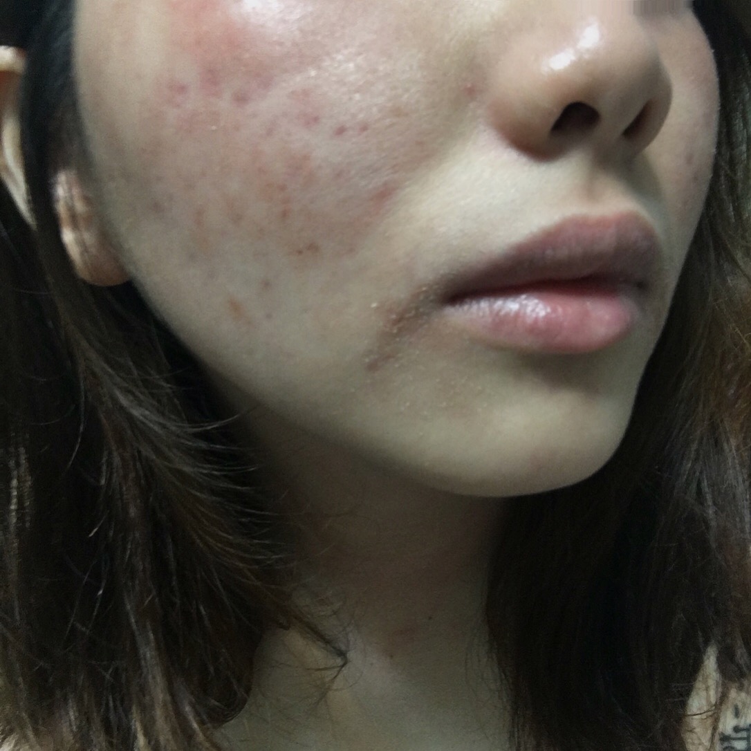 redness-flaky-burning-rash-after-2-months-in-and-photo-attached-the