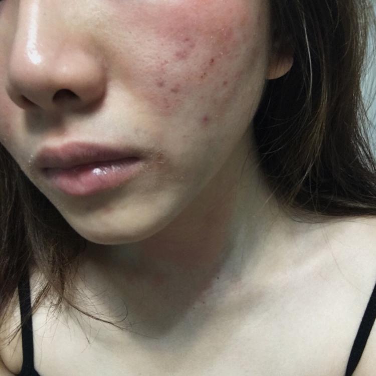 redness-flaky-burning-rash-after-2-months-in-and-photo-attached-the