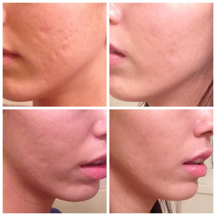 Post Subcision Results w/Picture - Scar treatments - by Kazalea - Acne