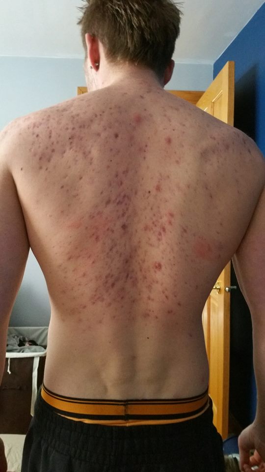 Fresh red scars (Back is annihilated) – Hypertrophic (raised) scars – Acne.org Forum