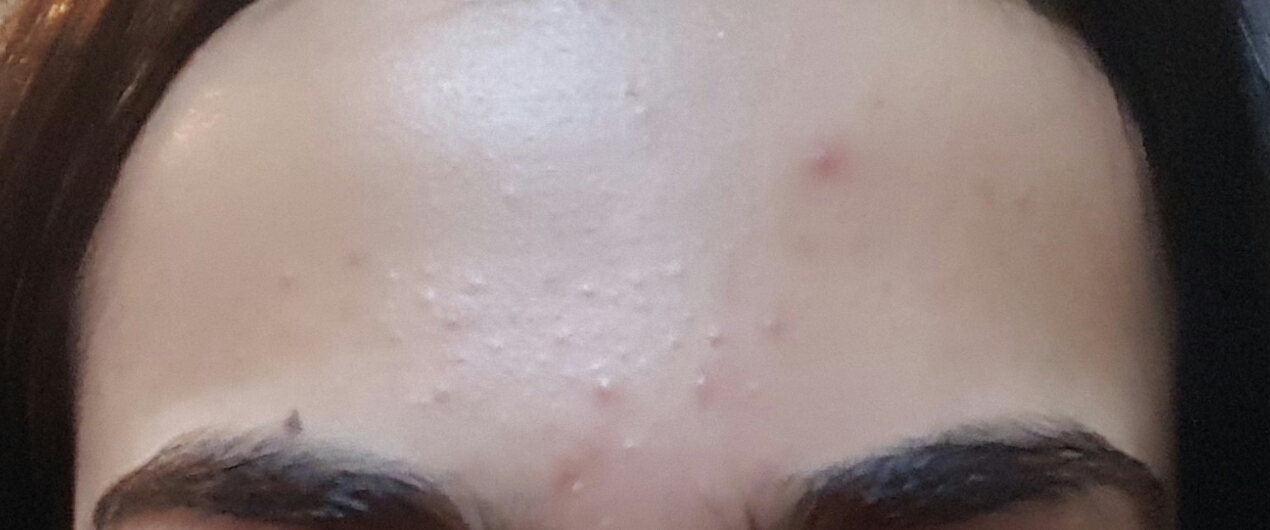 Forehead bumps: candida overgrowth? - Adult acne - by TenderGun - Acne ...
