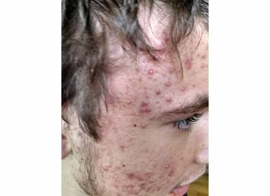 bad acne pic.jpg