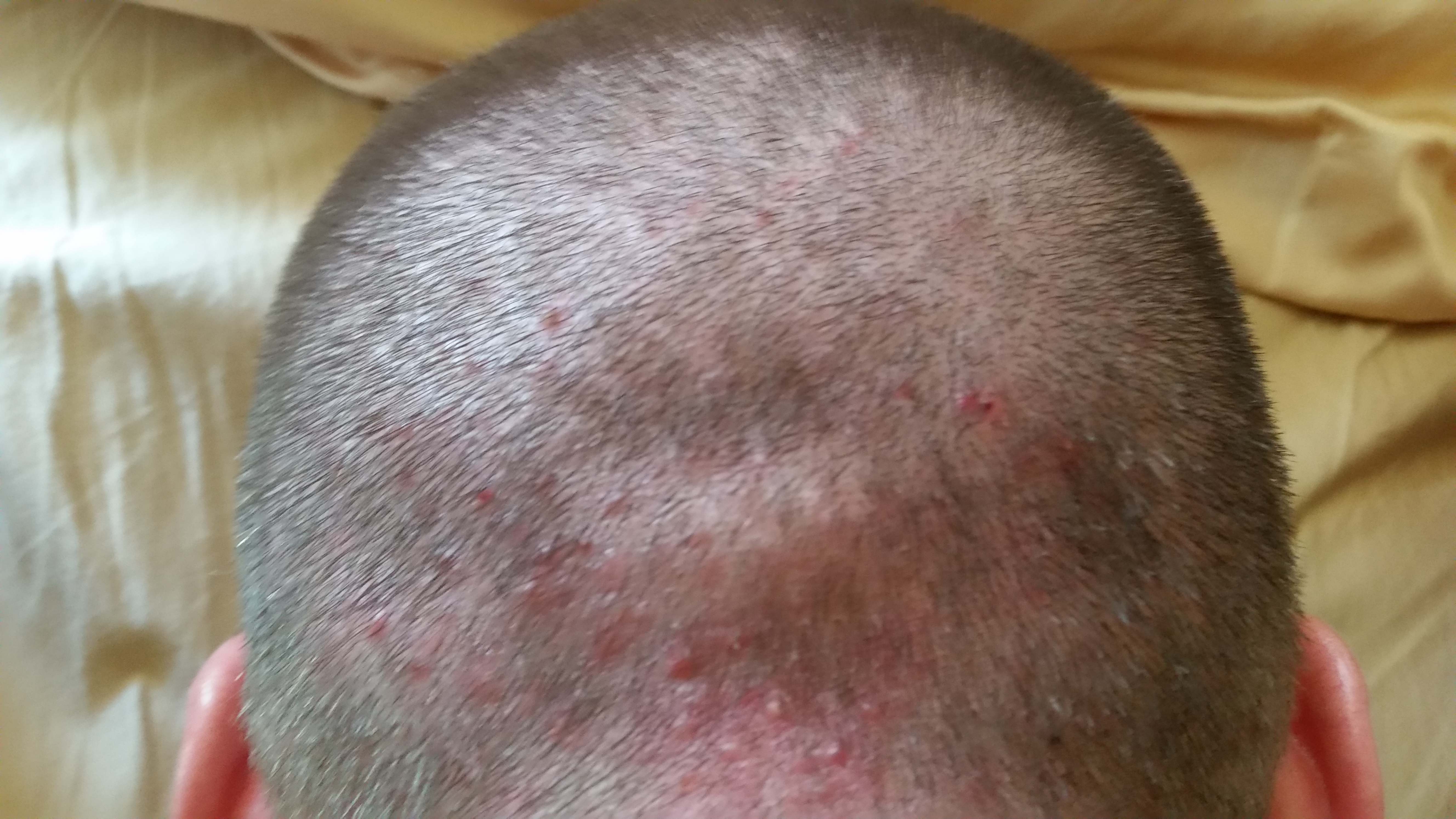 folliculitis scalp cure