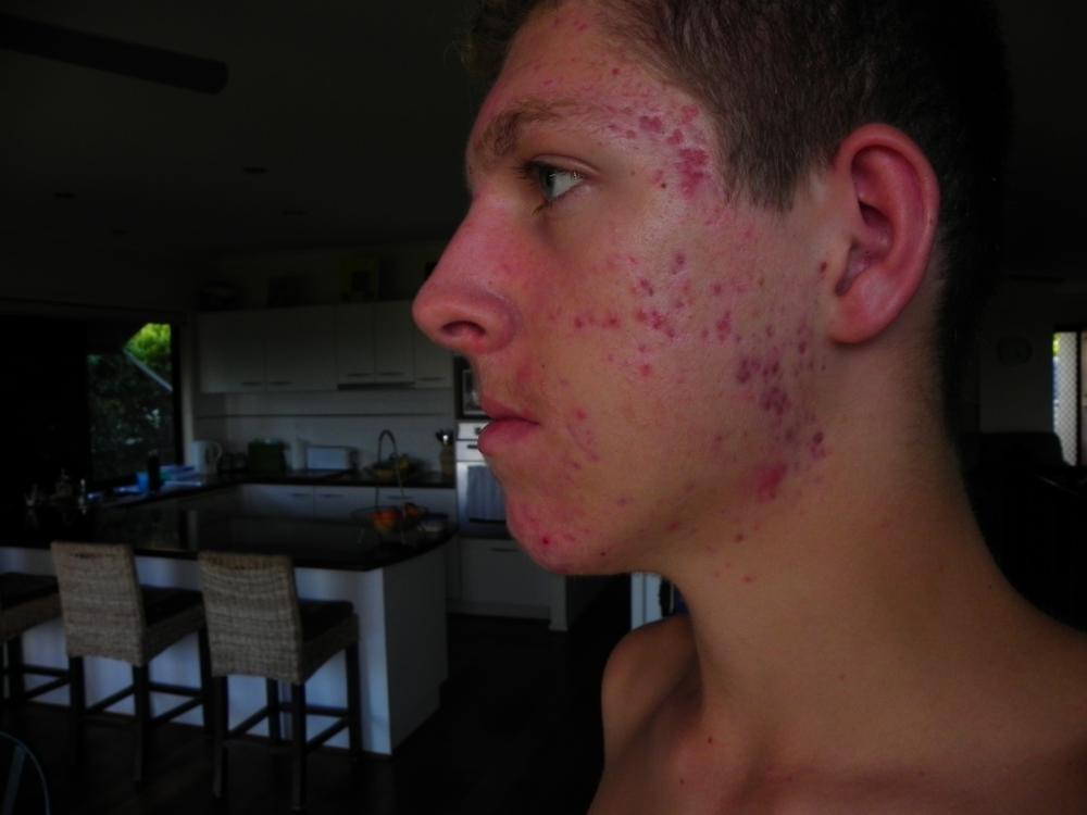 Accutane cost australia