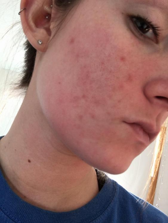 Horrible Post Acne Marks Scar Treatments Acne Forum