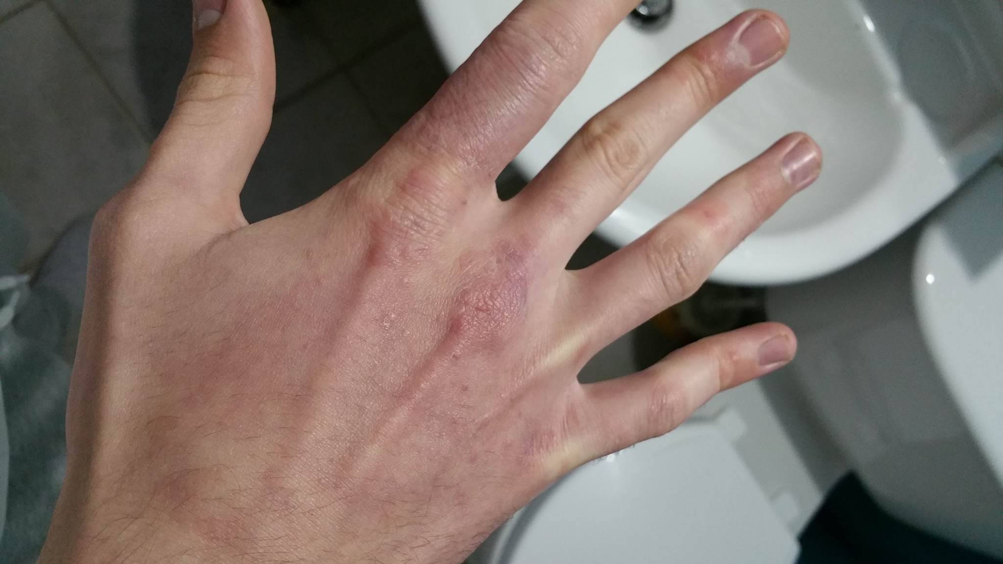Hand Rash On Accutane Prescription Acne Medications By Nick100998