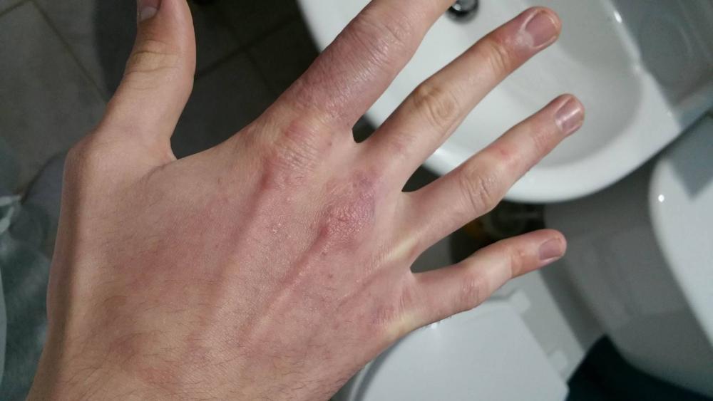 HAND RASH ON Accutane Prescription acne medications