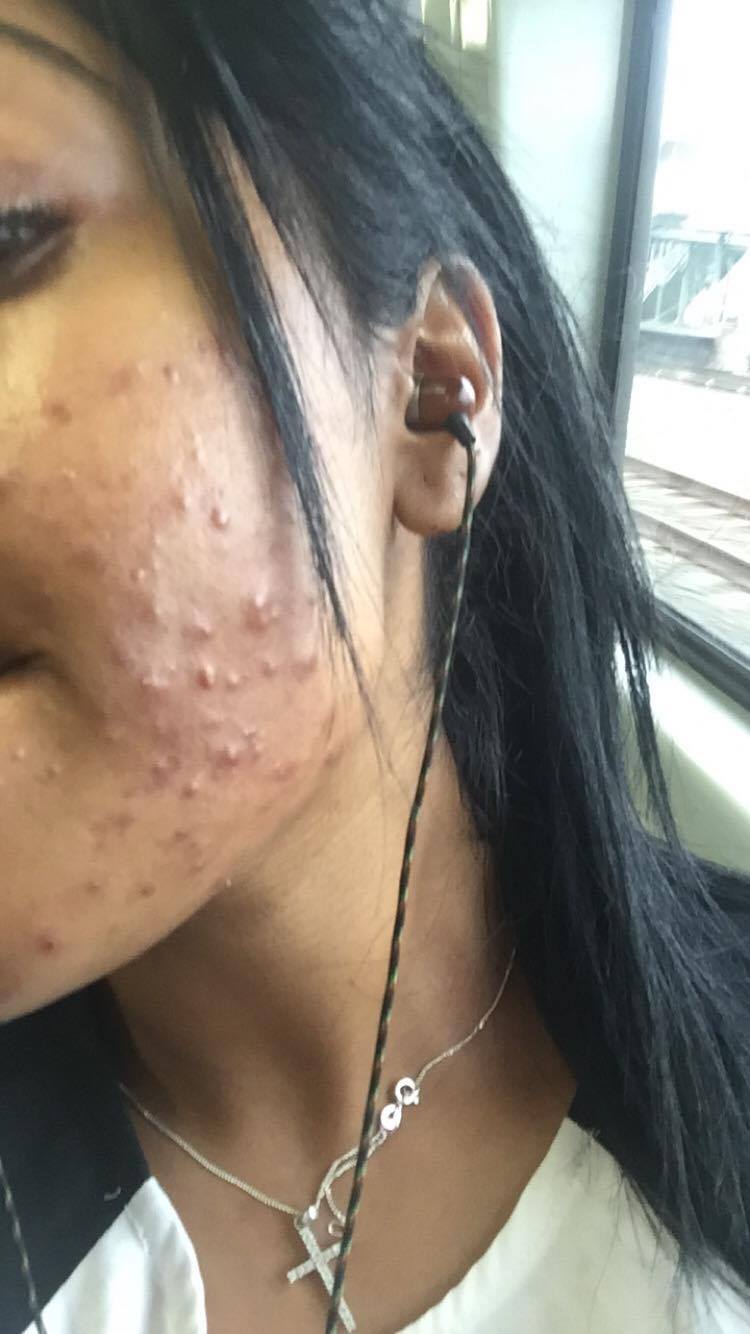 make skin your accutane worse can