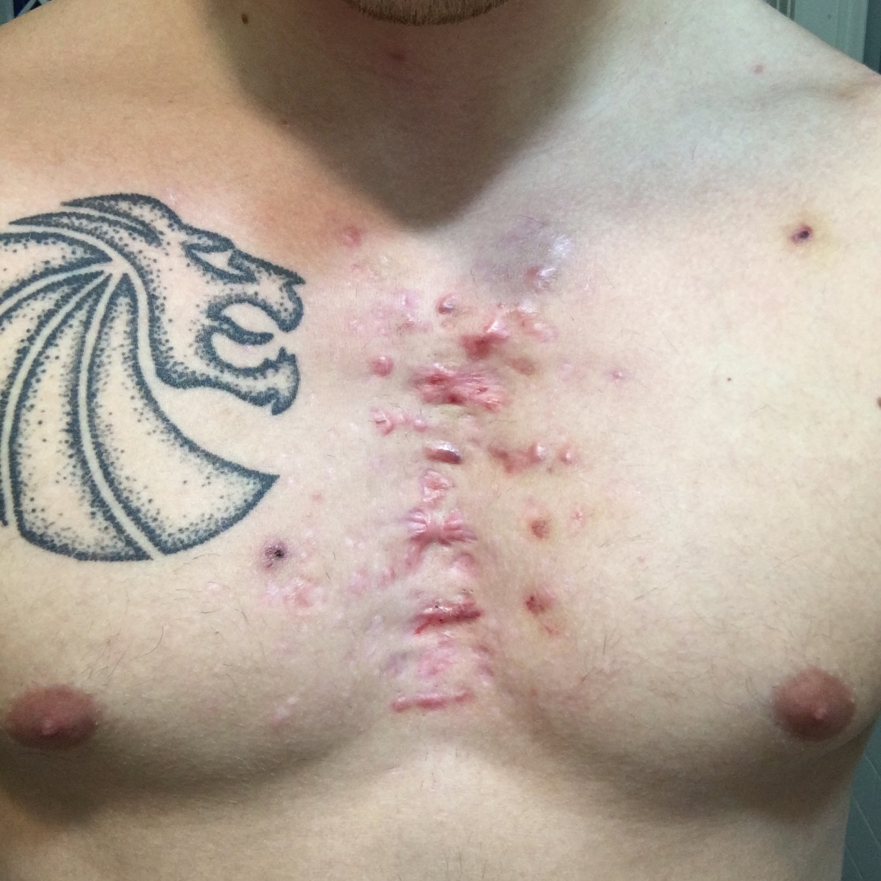 chest scar