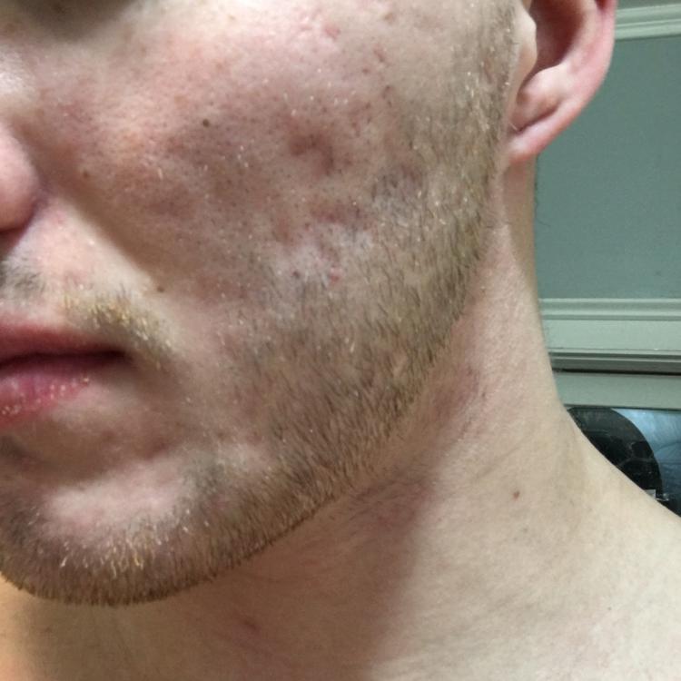 Bad scarring on chest and back. Dark spots on face - Scar 