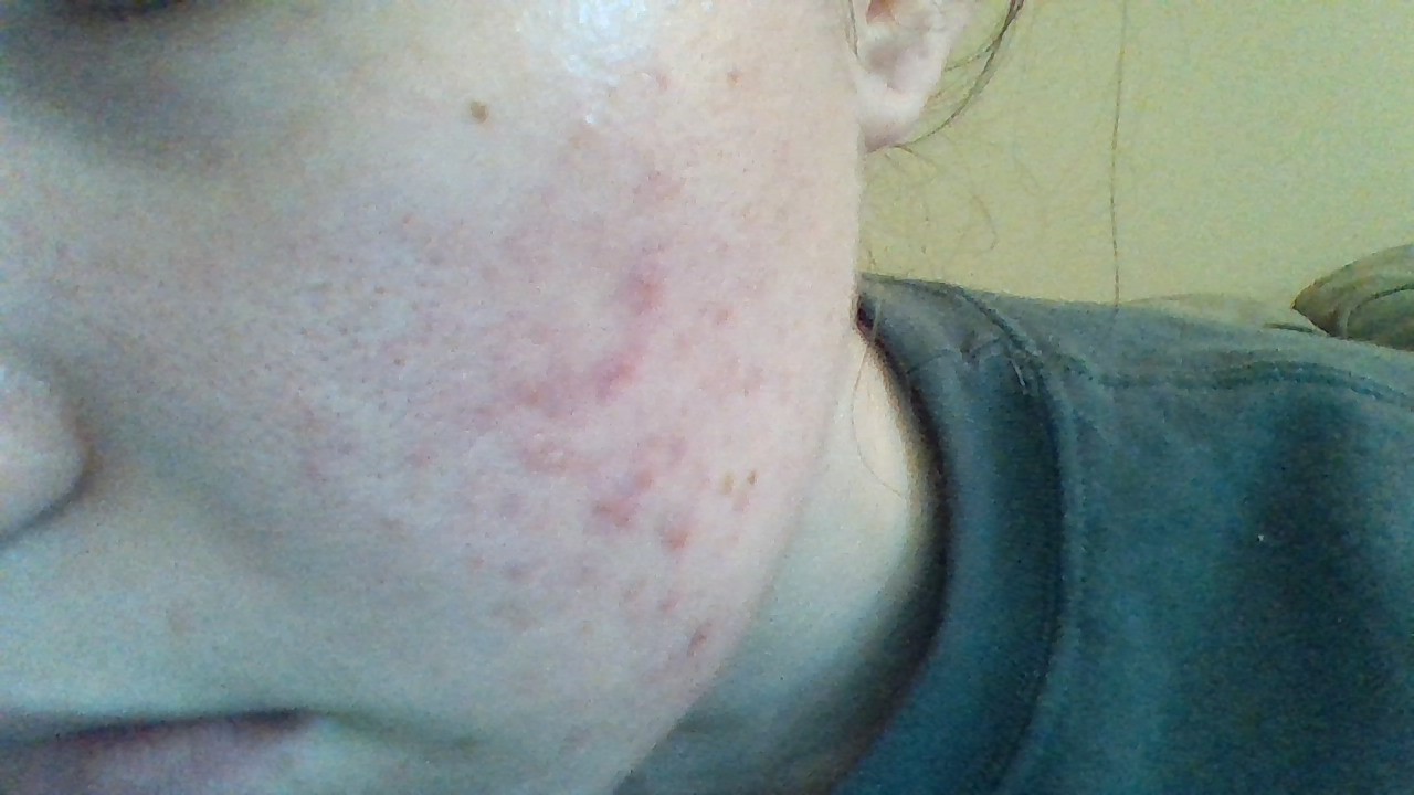 Horrible Acne, Oily Skin, So Depressed! – General Acne Discussion 