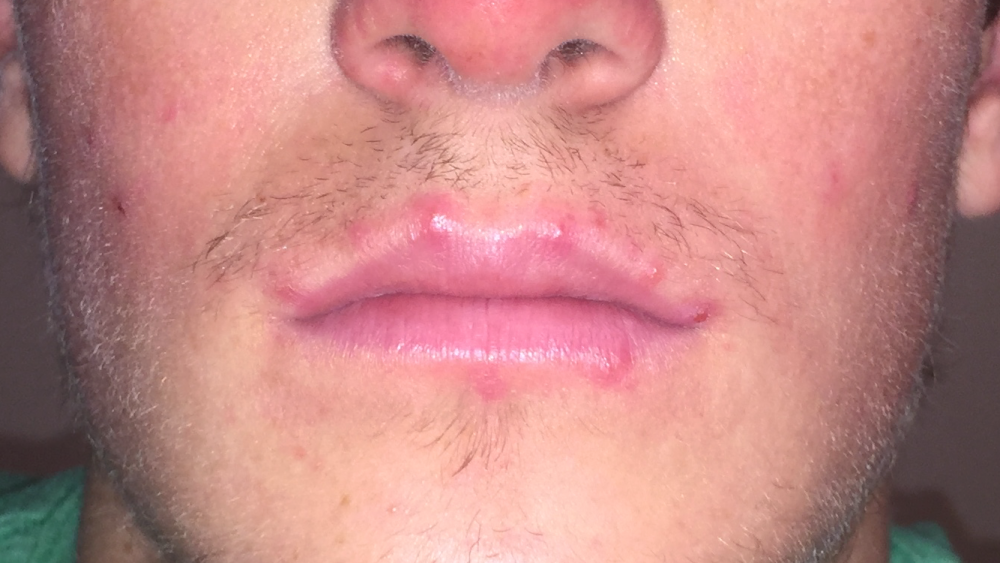 Spots On Edge Of Lips