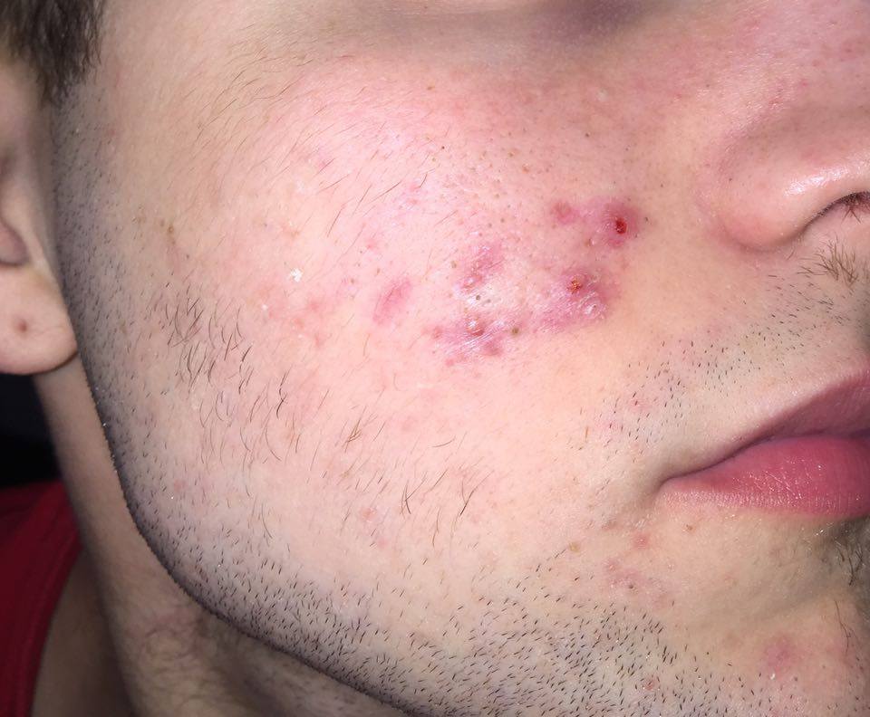 Pimples/Hyperpigmentation/Scars that won't go away 