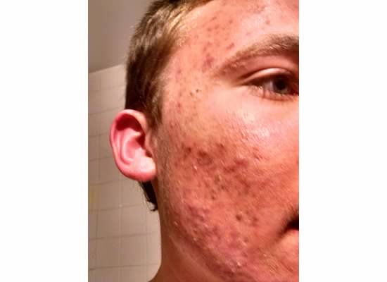 Zack acne part 2-4.jpg