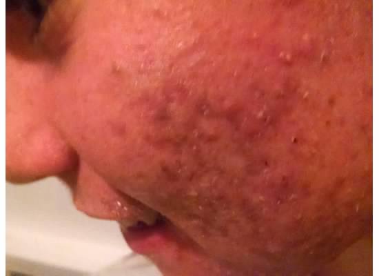 zack acne part 2-7.jpg