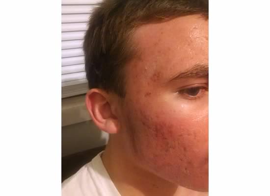 zack acne part 2-5.jpg