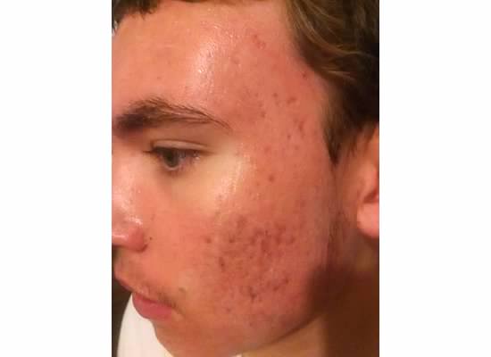 zack acne part 2-8.jpg