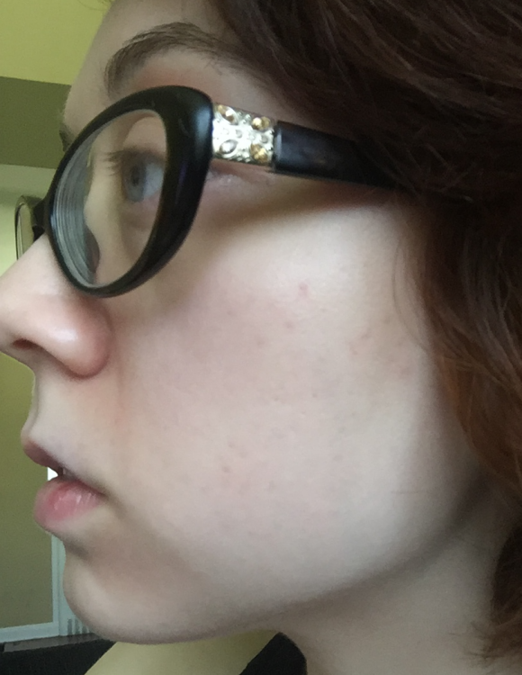 57100242d0a8d_AcneLeft2.thumb.png.151387